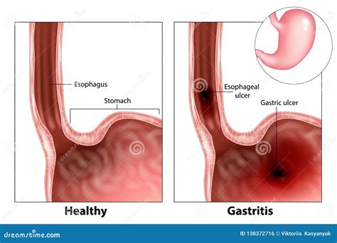 Gastritis And Esophageal Ulcer Vector Illustration | CartoonDealer.com ...