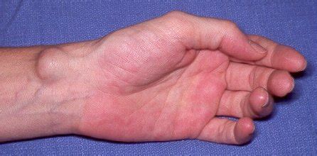 ganglion cyst wrist knee foot ankle pictures surgery removal