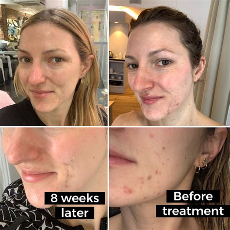 Light Acne Treatment ESPADA™ Blue Light Acne Treatment • Pink