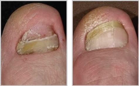 Лечение грибка ногтей на ногах и руках лазером в Иркутске – цены ...