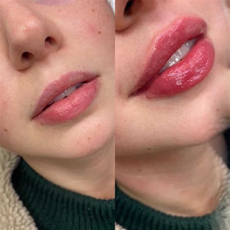 1ml Lip Fillers | Lips inspiration, Lip fillers, Lip fillers juvederm