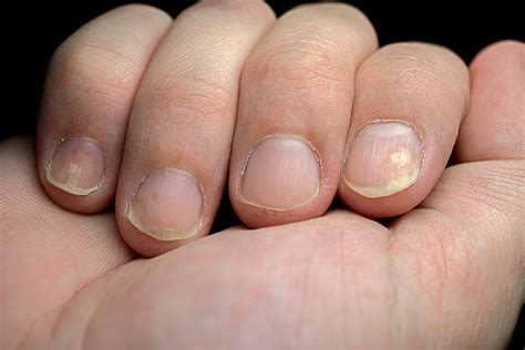 fingernails  white spots  george chavis blog
