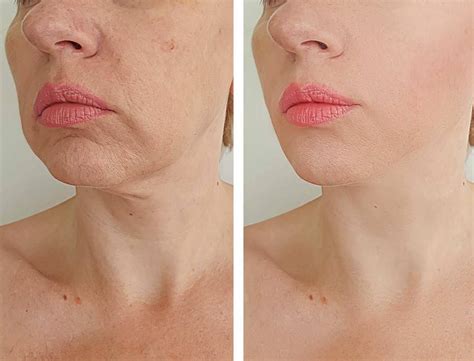 Best Anti Aging Skin Treatments for 50s and Older Boston, MA