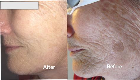 Age Spots On Face Removal