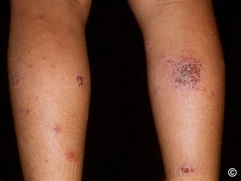 Eczema - discoid eczema