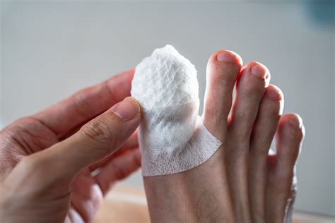 Toe Arthroplasty | Synergy Health Partners