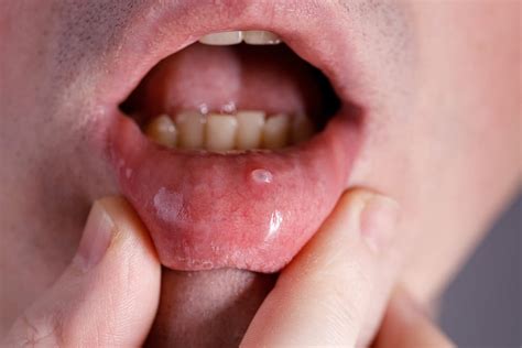 Mucocele: causas, tipos e tratamento - Dr. Pablo Quintana