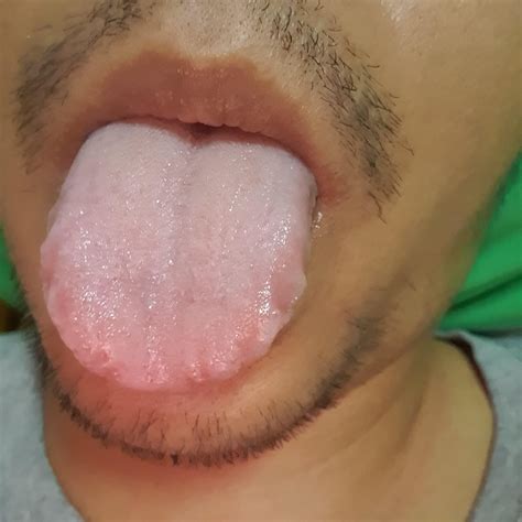 "NAD" Does this look like hairy leukoplakia or scalloped tongue? and I