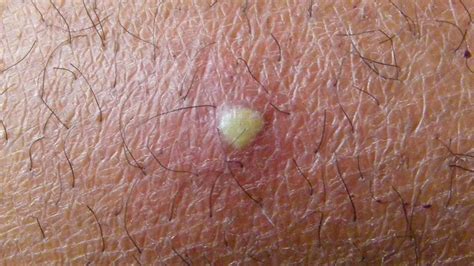 Boil on Skin: Treatment, Causes, and More