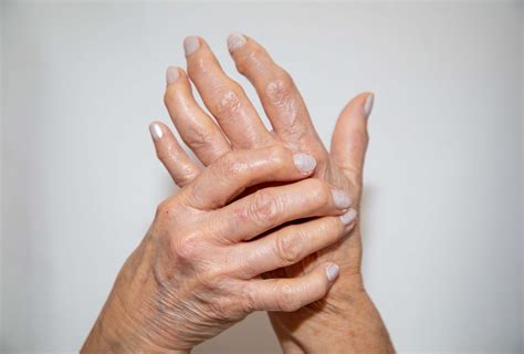 Types of Rheumatoid Arthritis