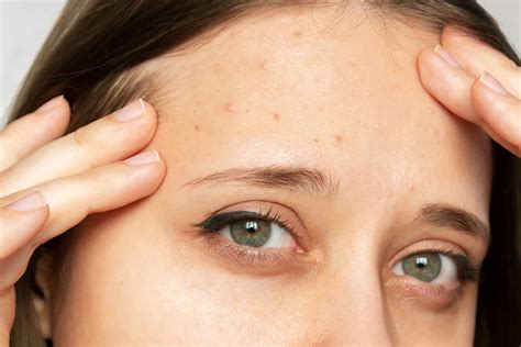 candida  acne find   truth beauty   skin