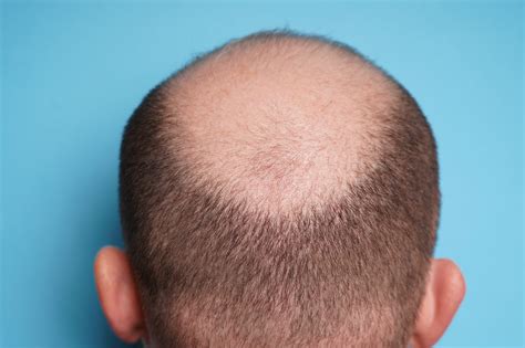 Why Do Humans Go Bald? | Discover Magazine