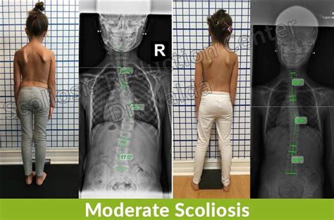 Moderate Scoliosis