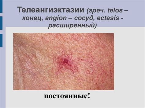 Морфологические элементы сыпи - презентация онлайн