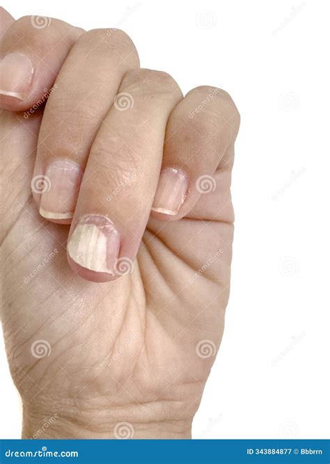 Problematic Hands with Separation of Flesh and Nails on White Stock