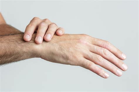 Eccema dishidrótico: qué es y cómo debes tratarlo