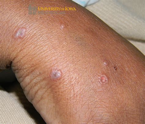pink papules  vesicles   central erosion