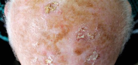 pre skin cancer keratosis