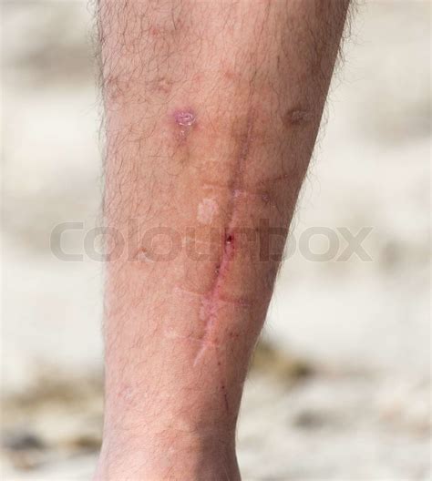 scars on his leg | Stock image | Colourbox