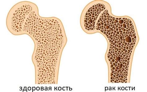 Рак костей: симптомы, диагностика, лечение и профилактика