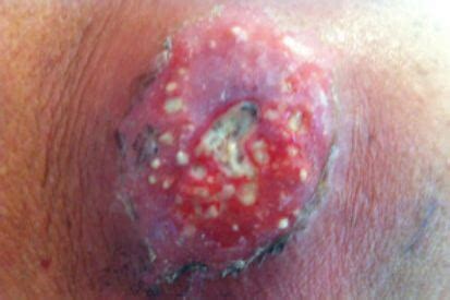 Abscess-Boil: Symptoms and Treatment | The Dermatology & Skin Surgery ...