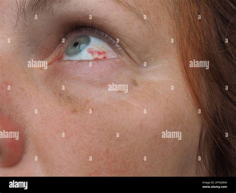 Subconjunctival hemorrhage or subconjunctival bleeding, hyposhagmus ...