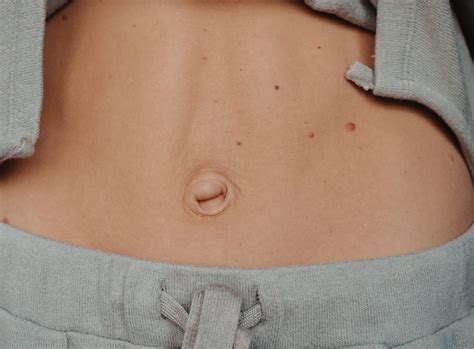 umbilical hernia belly button bulge singapore ark surgical