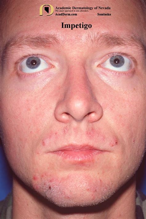 Mild Impetigo Treatment