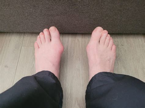 Are these bunions? If so any advice on what to do, left one is giving
