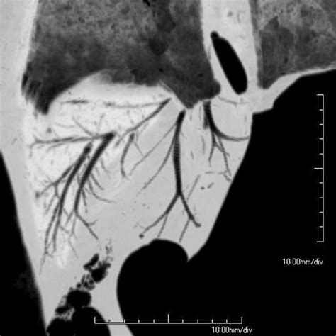 Кессонная болезнь — 24Radiology.ru