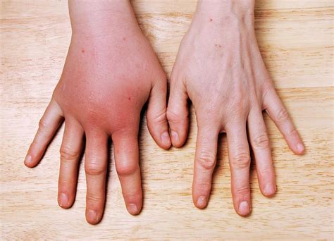 bee sting photograph  cordelia molloyscience photo library pixels