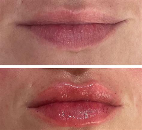 Lip Injections Before And After Pictures:
