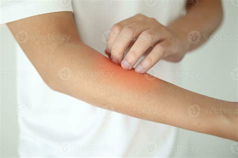 man itching and scratching on arm from itchy dry skin eczema dermatitis