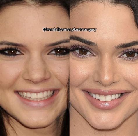 Kendal Jenner | Celebrity plastic surgery, Bad celebrity plastic ...