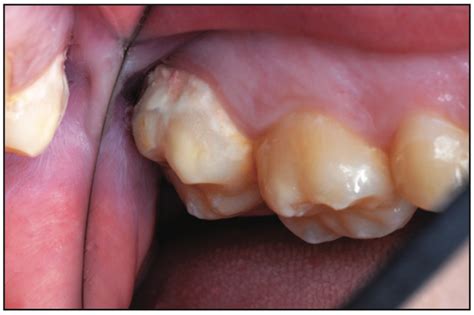 Treatments Of Dental Crown Caries, Root Surface Caries, And, 47% OFF