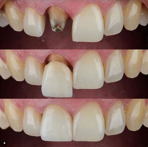 front tooth single crown  root canal artofit