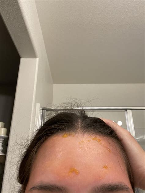 2nd degree sunburn. Was curious if anyone could give me some insight ...