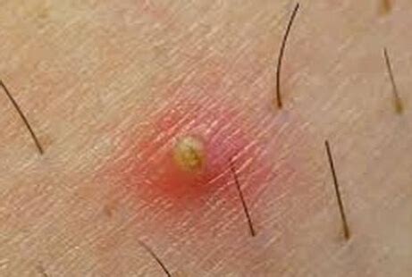 Painful Lump in Armpit | New Health Advisor