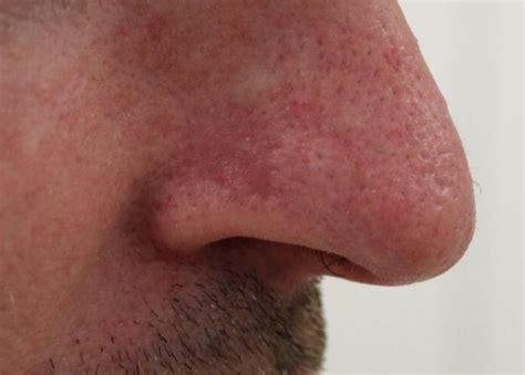 Scars 02 | Brisbane Skin, Dermatologist Brisbane. Medical, surgical ...