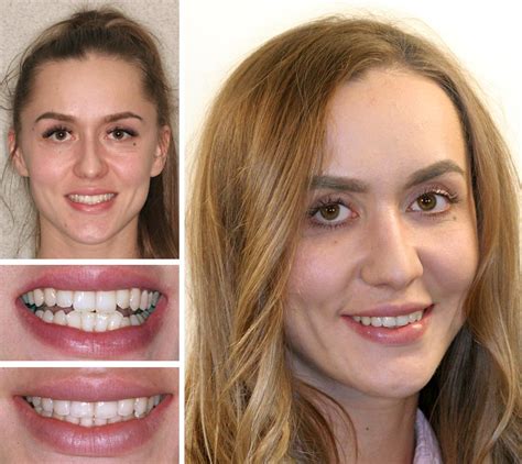 Clear Damon Braces