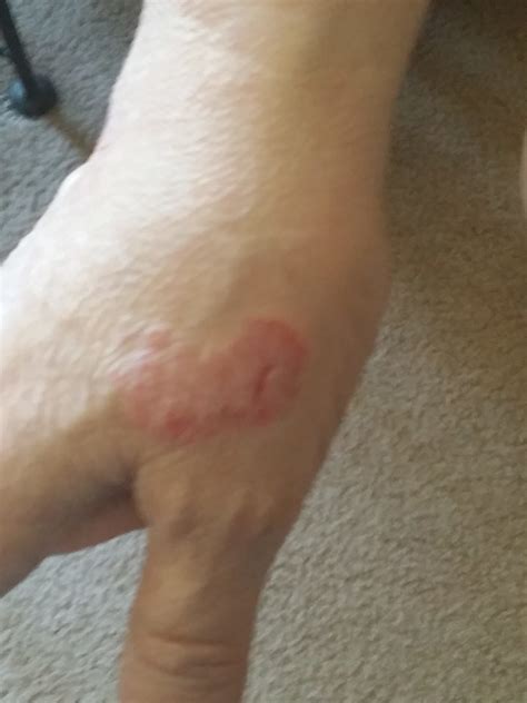 Carpet Allergy Skin Rash at William Stork blog