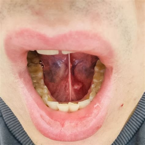 What Is Ranula? (5 Detailed Causes, Symptoms, & Treatments)
