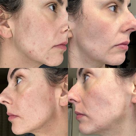 1 month into tret combo + YAZ : r/tretinoin