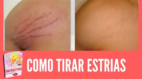 Estria Roxa No Peito