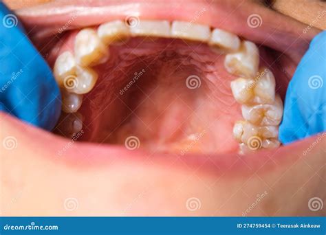 close    upper jaw hard palate soft palate teeth  gums