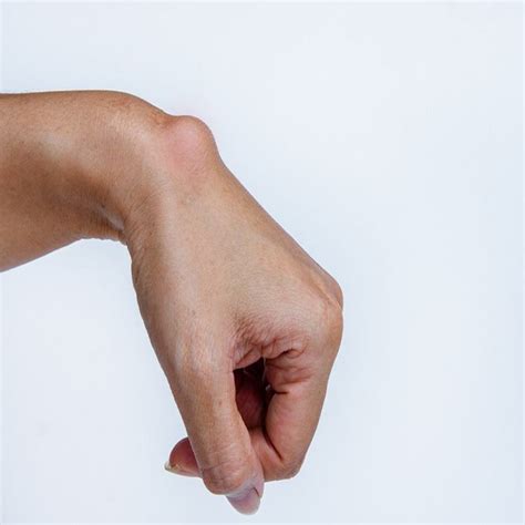 Ganglion Kisti - Kadın Hastalıkları