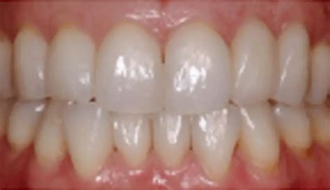 interproximal reduction alexander martin orthodontics sacramento