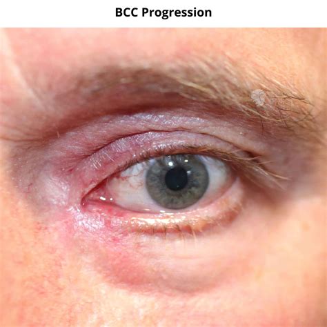 Patients BCC progression - Dr Anthony Maloof, Sydney.