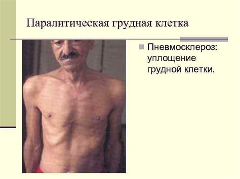 Осмотр грудной клетки Конституционные типы: n астеник