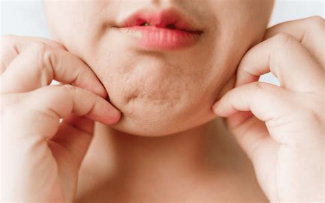 puffy face  treatments skincare tips  derm spot